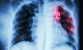 TÜBERKÜLOZEĞİTİMİ