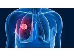 TÜBERKÜLOZ EĞİTİMİ